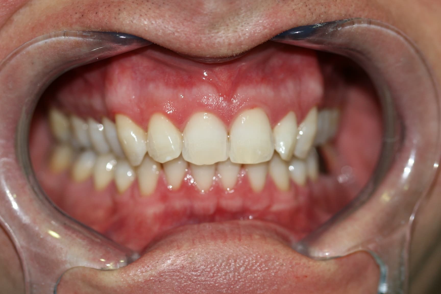 After smile transformation