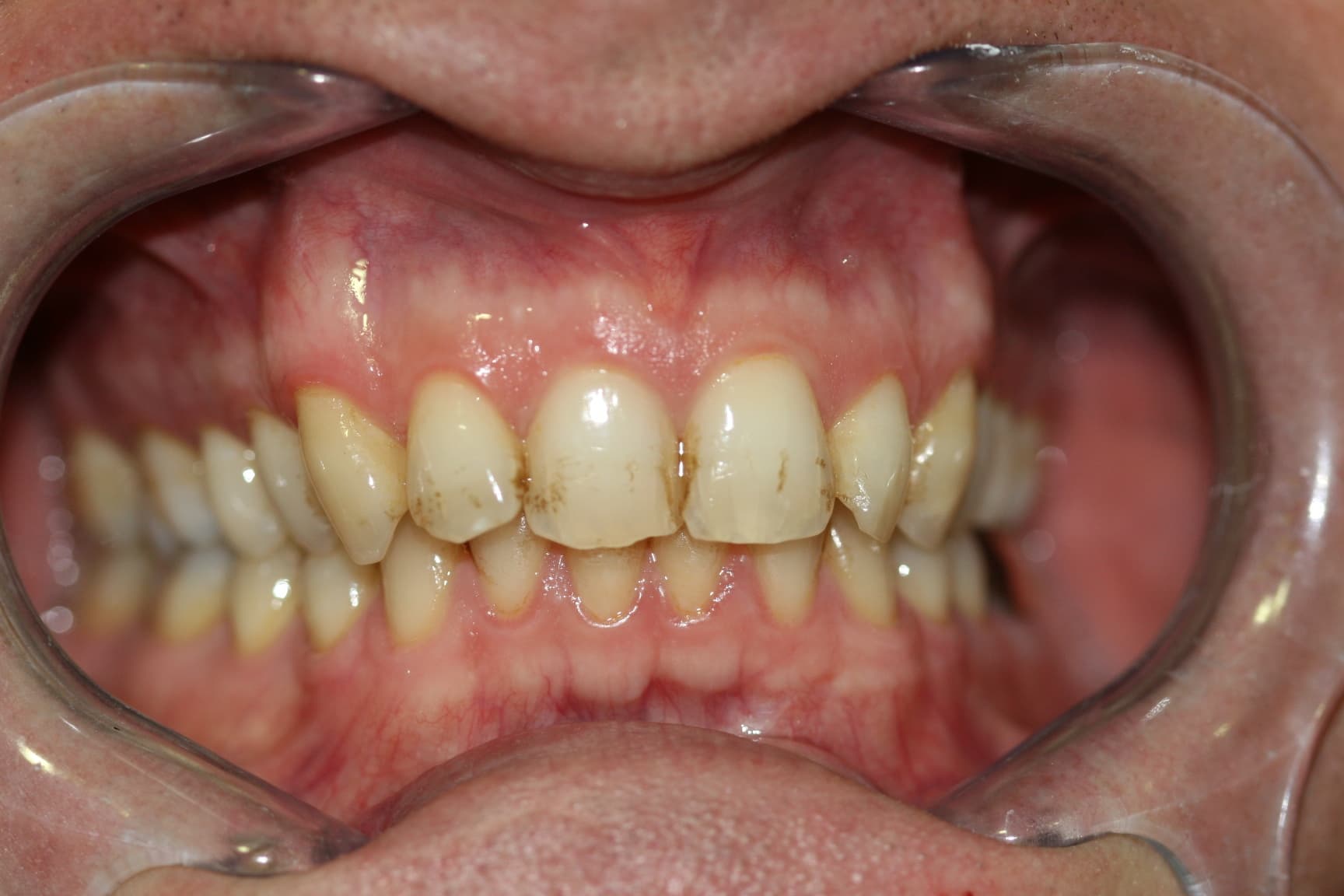 Before smile transformation